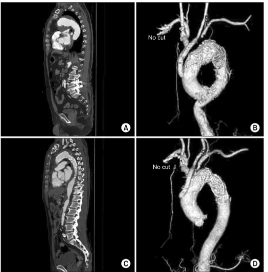 Fig. 3. Postoperative 3D thoracic  aorta CT. These figures showed the  complete coverge of aortic  aneur-ysm and aortic dissection without  endoleak (A, C)