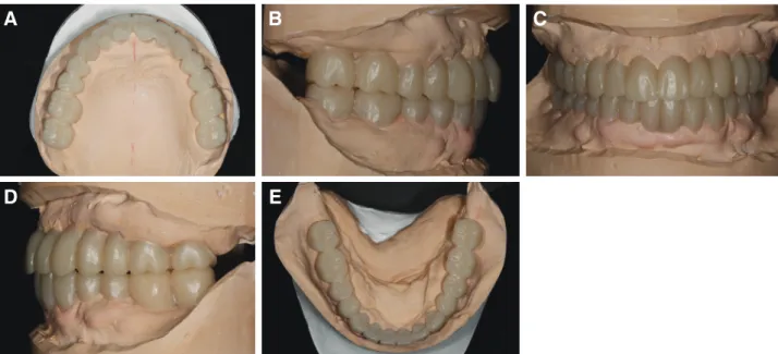 Fig. 5. Diagnostic wax-up cast model. (A) Upper view, (B) Right view, (C) Frontal view, (D) Left view, (E) Lower view.
