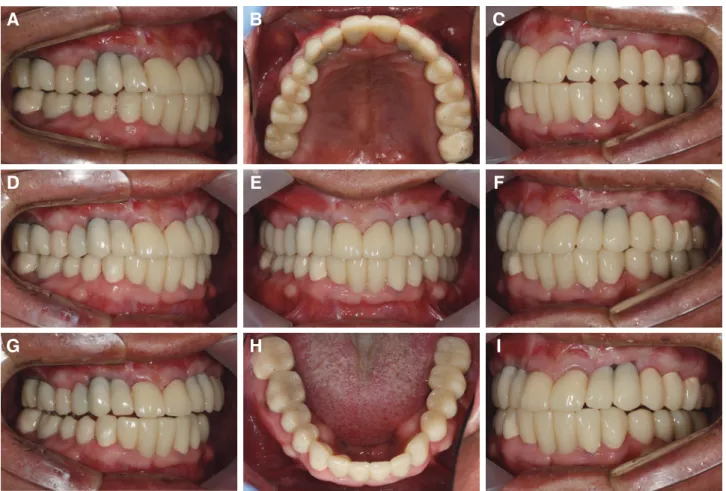 Fig. 8. Provisional restoration. (A) Rt balancing, (B) Upper view, (C) Lt working, (D) Right view, (E) Frontal view, (F) left  view, (G) Rt working, (H) Lower view, (I) Lt balancing.