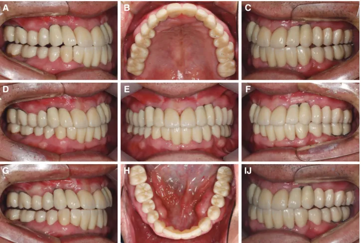 Fig. 11. Definitive restoration. (A) Rt balancing, (B) Upper view, (C) Lt working, (D) Right view, (E) Frontal view, (F) left  view, (G) Rt working, (H) Lower view, (I) Lt balancing.