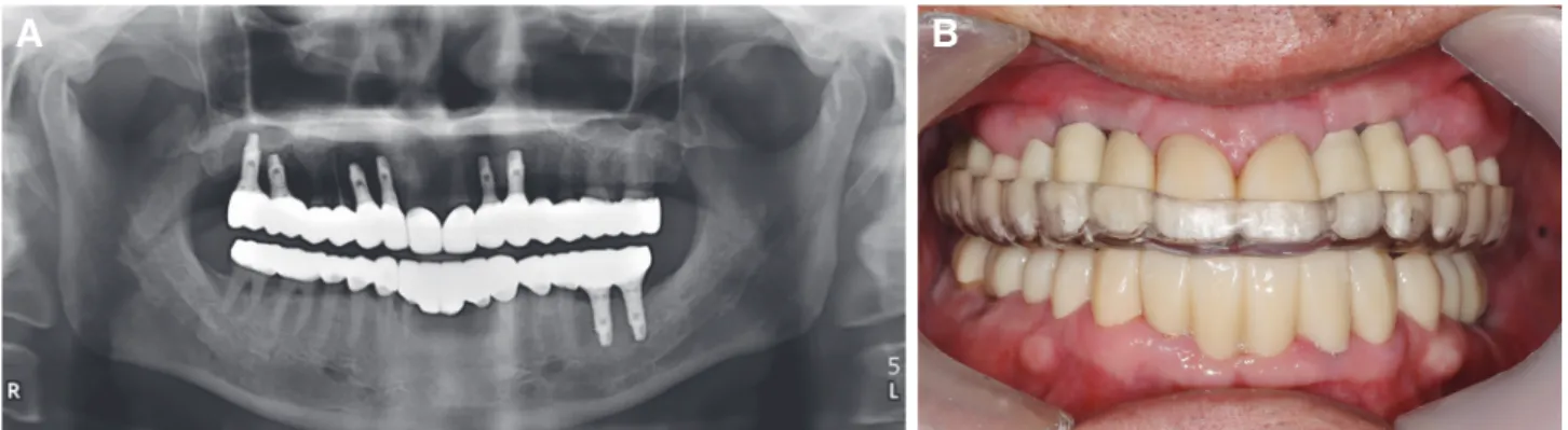Fig. 12. (A) Panoramic radiograph after treatment, (B) Night guard.