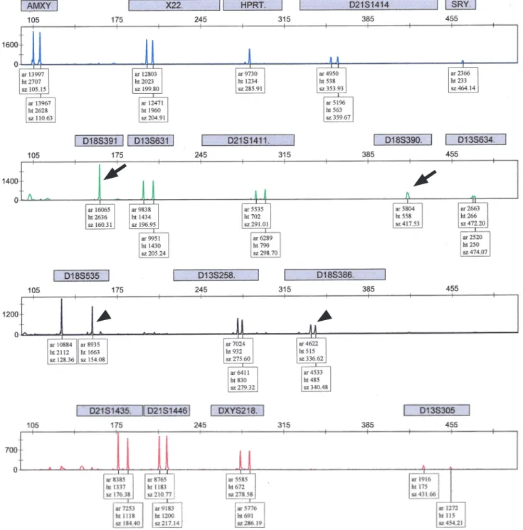 Fig. 1. Normal quantitative fluorescent polymerase chain reaction results with peak height ratios of allele dosage between 0.8 and 1.4 in more  than two short tandem repeats (arrow head) in 46, XY, based on at least two informative markers, except for two 