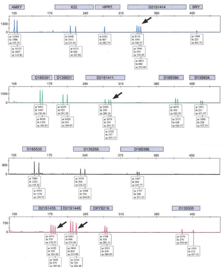 Fig. 2. Positive quantitative fluorescent polymerase chain reaction results with the main short tandem repeat markers in 47, XY, +21: Tri- Tri-somy 21 is determined by the trisomic triallelic pattern for D21S1414, D21S1411, D21S1435, and D21S1446 (arrow)