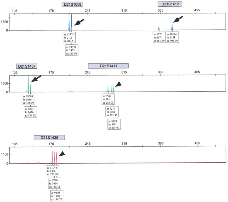 Fig. 3. Positive quantitative fluorescent polymerase chain reaction results with extra short tandem repeat markers in 47,XY,+21: Trisomy  21 is identified by a trisomic diallelic pattern for D21S1008, D21S1412, and D21S1437 (≤0.6 or ≥1.8) (arrow) and a tri