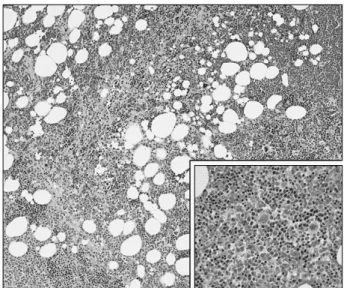 Fig. 2. Intraoperative photograph shows hemorrhagic cystic mass  covered by parietal pleura.