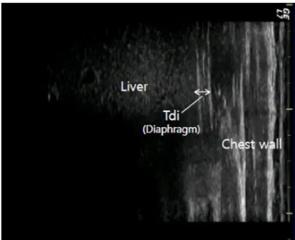 Fig. 1. Ultrasound  image  of  the  diaphragm  in  the  zone  of  apposition.  Tdi:  diaphragm  thickness