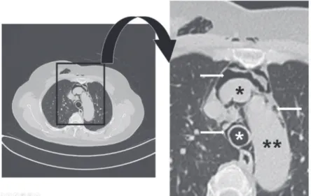 Fig. 1. A chest x-ray (A) and cervical x-rays (B and C) show the large amount of subcutaneous emphysema