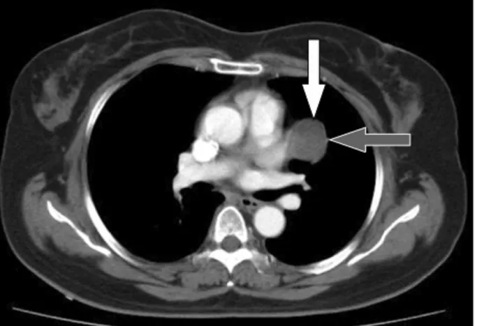 Fig. 2. Preop chest MRI. It suggests that the middle mediastinal  mass would be infected pericardial cyst.