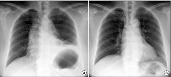 Fig. 4. (A) An immediate post operative chest pa. It shows that the left diaphragm is elevated