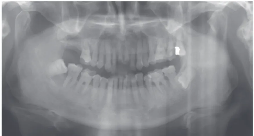 Fig. 1. Initial panoramic radiograph.