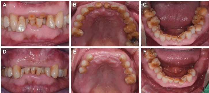 Fig. 2. Intraoral photograph. (A - C) At first visit, (D - F) At re-visit after extraction of teeth.