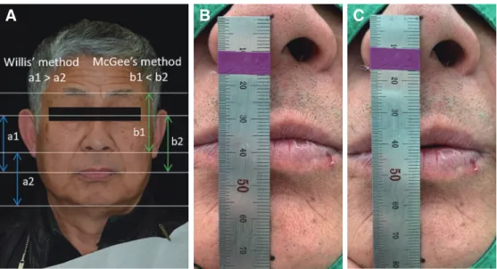 Fig. 4. Vertical dimension evaluation. (A) Facial appearance evaluation, (B) interocclusal rest distance evaluation  (maximum intercuspation), (C) interocclusal rest distance evaluation (physiologic rest position).