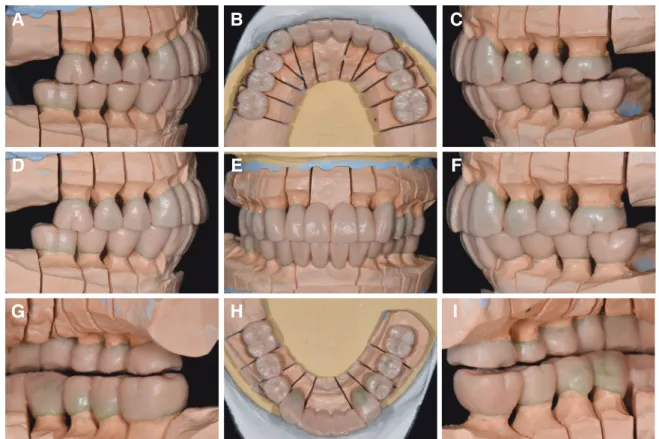 Fig. 10. Wax-up pattern for definite prosthesis. (A) Working side during right lateral excursion, (B) Maxillary occlusal view,  (C) Non-working side during right lateral excursion, (D) Left lateral view at centric occlusion, (E) Frontal view at centric  oc
