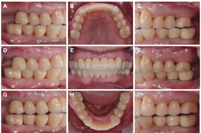 Fig. 12. Intraoral photograph after the placement of definitive prosthesis. (A) Working side during right lateral excursion,  (B) Maxillary occlusal view, (C) Non-working side during right lateral excursion, (D) Left lateral view at centric occlusion,  (E)
