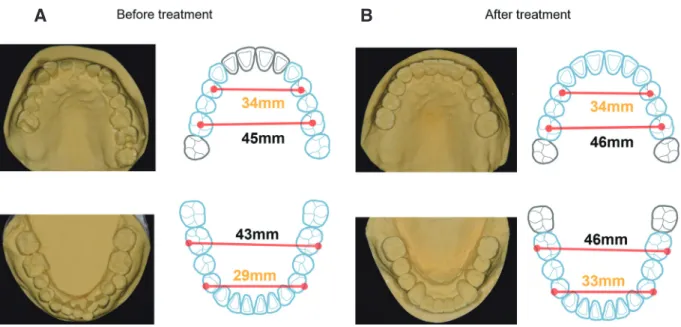 Fig. 15. Chewing pattern analysis. (A) Initial stage of right side, (B) Initial stage of left side, (C) Definitive restoration stage  of right side, (D) Definitive restoration stage of left side.