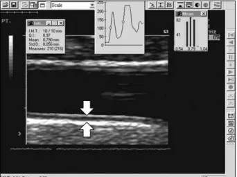 Fig. 1. This figure shows intima-media thickness. The distance be- be-tween the arrows is intima-media thickness.