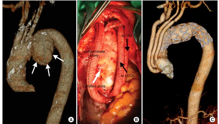 Fig. 1. Debranching with re-routing of all arch vessels and endovascular stent graft repair of aortic aneurysm (Patient 3)