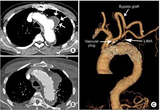 Fig. 3. Left carotid-axillary bypass  grafting and endovascular repair  (Patient 8 who underwent coronary  artery bypass grafting using left  in-ternal mammary artery 4 years  ago)