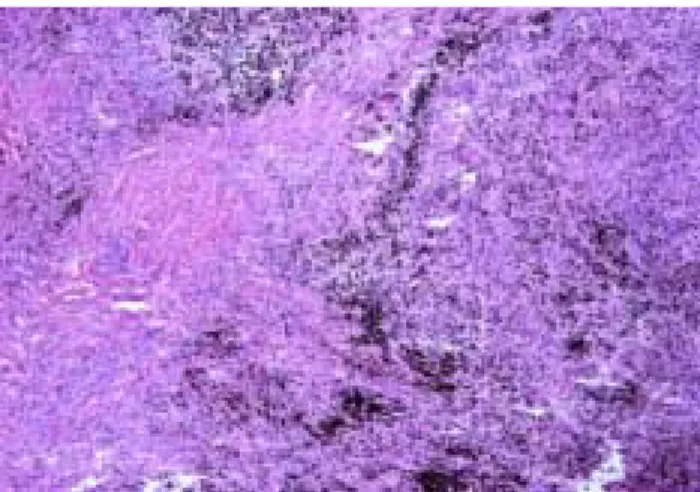 Fig.  7.  Histopathologic  exam  in  patient  2  (Hematoxyline-Eosin  stain  X  200).  (No  malignant  evidence