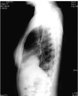 Fig.  2B.  Preoperative  chest  computed  tomogram  show  a  subpleural  metastatic  nodule  in  the  right  lower  lobe.