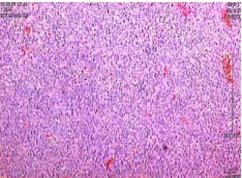 Fig.  3.  Microscopic  finding  of  the  tumor.  Spindled  cells  and  ovoid  cells  are  arranged  in  fascicular  or  some  storiform  pattern.(Hematoxylin  &amp;  Eosin  stain,  x40)