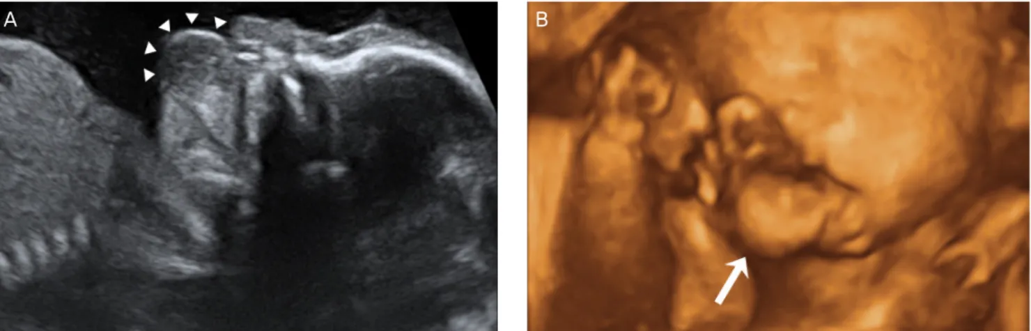 Fig. 2. Sagittal HASTE T2-weighted magnetic resonance image at 21 weeks 6/7 days of gestation showing a 16×10 mm hyperintense mass (arrows) with a stalk (ar- (ar-rowhead) projecting from the palate and upper lip (UL) (A)