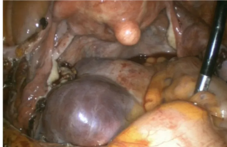 Fig. 2. Laparoscopy shows that bluish-colored huge mass is located along the  sacrum in the pelvic retroperitoneum