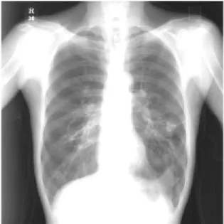 Fig.  2.  Preoperative  chest  CT  scan  shows  diffuse  severe  emphysematous  changes  of  both  lung  parenchyma.
