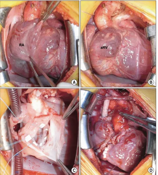 Fig. 2. Operative findings including  dilated right atrium (RA) (A),  atria-lized right ventricle (aRV) (B),  multi-ple plication on internal wall of  functional right ventricle (C), and  completion of right ventricle  ex-clusion procedure with right modif