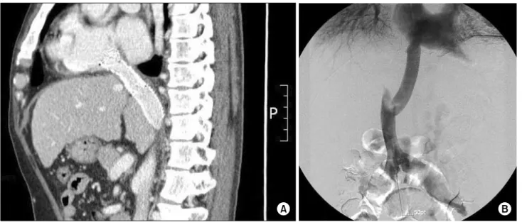 Fig. 3. (A) Postoperative sagittal section of CT shows the ringed PTFE graft &amp; Endovascular stent