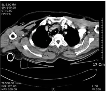 Fig. 2. Intraoperative finding of patient with right main bronchial  injury. 