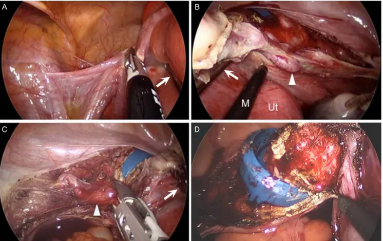 Fig. 1. Intraoperative findings in single-port access total laparoscopic hysterectomy