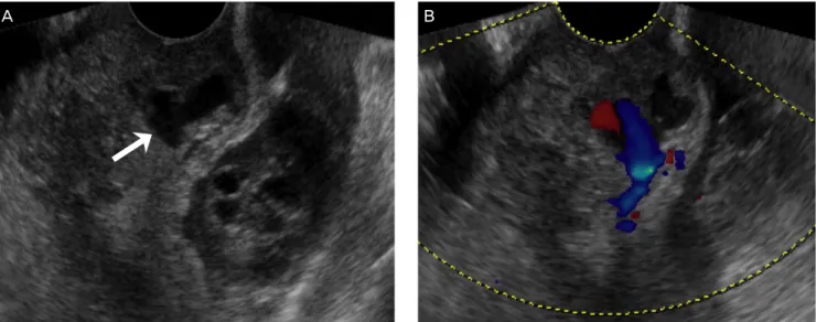Fig. 2. Angiographic computed tomography (A) and 3-demensional reconstruction image (B)