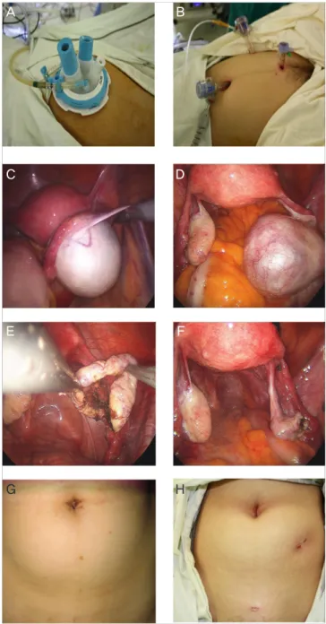 Fig. 1. Laparoendoscopic single-site surgery (left) and conventional laparo- laparo-scopic surgery (right) for ovarian mature cystic teratoma