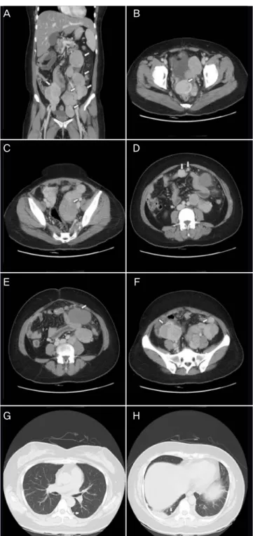 Fig. 1. Multiple metastatic leiomyomatosis in a 39-year-old woman. Con- Con-trast enhanced 3-dimensional multi-detector computed tomography images  show several well-defined masses (arrows) in abdomino-pelvic cavity (A)