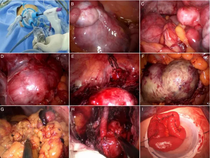 Fig. 2. Operative findings. Single port system with OCTO Port (A). Multiple leiomyoma of near the left adnexae (B), Douglas pouch (C), near the left external  iliac vessel (D), and peritoneum (E)
