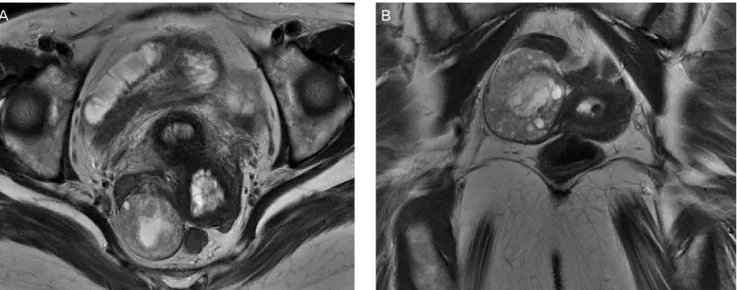 Fig. 1. (A,B) Pelvic dynamic magnetic resonance imaging shows multiple subendometrial cystic changes with mildly thickened endometrium and a  4.1×3.4-cm-sized, well-defined, multicystic lesion in the right adnexal portion.
