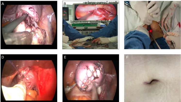 Fig. 1. Enucleation performed by applying traction on the myoma with two conventional laparoscopic clamps (A)