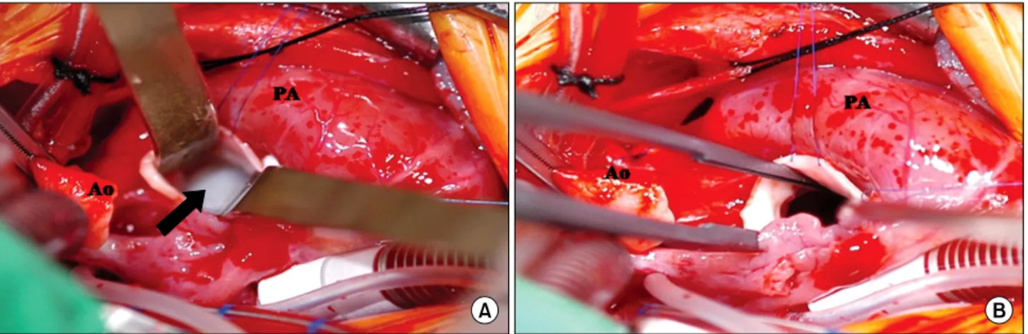 Fig. 2. Intraoperative surgeon’s view. (A) Whitish mass (solid arrow) obstructing left ventricular outflow tract was approached though the  transected aorta