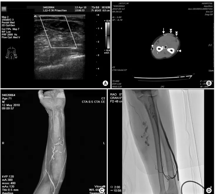 Fig. 2. (A) Preoperative Doppler sonography view showing dilated vein. (B) Preoperative upper extremity angio CT axial view: Black arrow  indicates cephalic vein, white arrow indicates median antebrachial vein, white arrow head indicated basilic vein, blac
