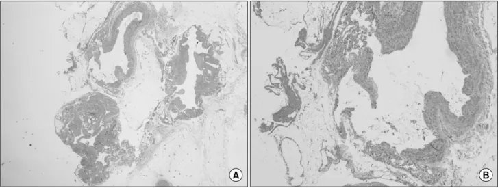 Fig. 3. Histologic finding of resected phlebectasia. (A) Contains whole venous vessel component (H&amp;E stain, ×12.5), (B) Contains whole  venous vessel component and showing dilated veins lined by a single layer of endothelial cells and irregular bundles