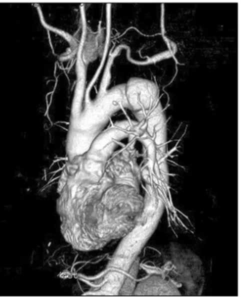 Fig. 1. Computerized tomography angiogram shows a 50 mm  sized saccular thoracic aortic aneurysm at 15∼20 mm distal area  from the orifice of a left subclavian artery