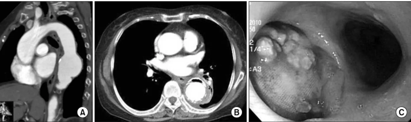 Fig. 1. (A) A chest computed tomography shows the saccular aneurysm at the descending thoracic aorta