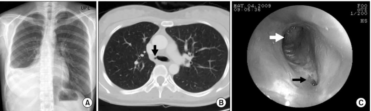 Fig. 1. Preoperative chest X-ray, computed tomography and bronchoscopic images. Black arrows indicate the narrowed right main  bronchus