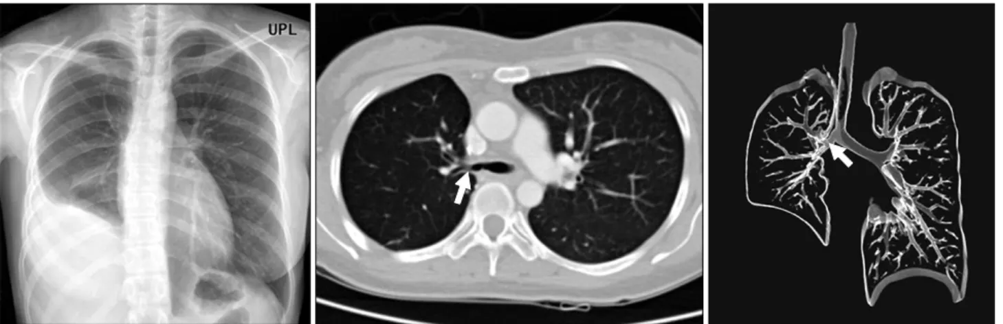 Fig. 3. Postoperative chest X-ray, computed tomography and 3-dimensional images. White arrows indicate the right upper lobar bronchus.