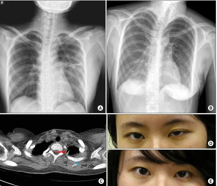 Fig. 1. Chest X-ray and CT show a malpositioned chest tube with its tip at the first intercostal space on the medial pulmonary apex (A,  C), and the chest tube was pulled back 2∼3 cm for repositioning (B)