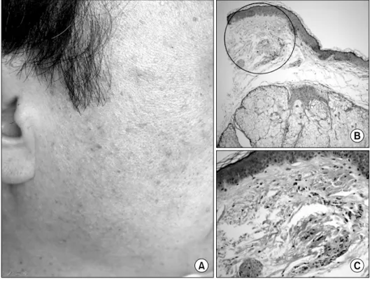 Fig. 1. (A) Skin manifestations  shows multiple, 3∼4 mm sized,  smooth, dome-shaped, skin to  whi-te-colored papules on the cheek