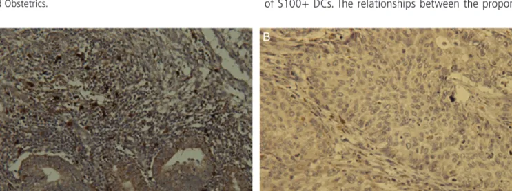 Fig. 1. Immunohistochemical staining of dendritic cell infiltration in endometrial carcinoma