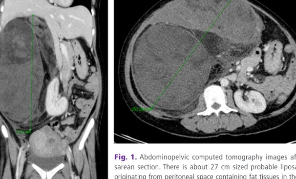 Fig. 1. Abdominopelvic computed tomography images after ce- ce-sarean section. There is about 27 cm sized probable liposarcoma  originating from peritoneal space containing fat tissues in them