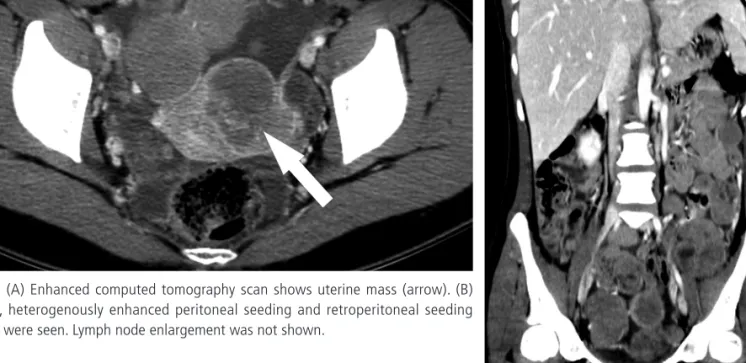 Fig. 1. (A) Enhanced computed tomography scan shows uterine mass (arrow). (B)  Ascites, heterogenously enhanced peritoneal seeding and retroperitoneal seeding  masses were seen